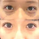 クマ治療 X CLINIC 銀座院 BEFORE サムネイル用