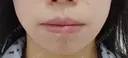 ボトックス（口角） YBC横浜美容外科 大宮院 BEFORE サムネイル用