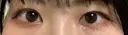 二重埋没 / 眼瞼下垂（非切開） BRIGHTS beauty clinic BEFORE サムネイル用