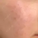 ピーリング（ニキビ・毛穴） まゆりなclinic 名古屋栄 BEFORE サムネイル用