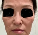 隆鼻術 / 鼻中隔延長（切開） / 軟骨移植 エースクリニック 名古屋院 BEFORE サムネイル用