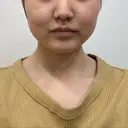 バッカルファット除去 / 脂肪吸引（顔） 湘南美容クリニック 京都院 BEFORE サムネイル用