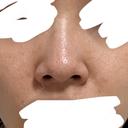 鼻尖形成（切開） / 軟骨移植 / 鼻尖縮小 ASTRA BEAUTY CLINIC BEFORE サムネイル用