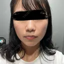 ボトックス（口角） / ボトックス（人中） L‘amour clinic Tokyo【ラムールクリニック東京】 BEFORE サムネイル用