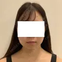 糸リフト / 脂肪吸引（顔） SEA CLINIC（シークリニック） BEFORE サムネイル用