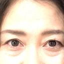 クマ治療 / 下まぶたの脂肪取り / ヒアルロン酸注入（目の下） ネビュラクリニック 広島院 BEFORE サムネイル用