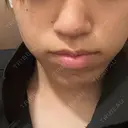 ボトックス（あご） TCB東京中央美容外科 金山院 BEFORE サムネイル用