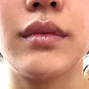 その他（目元） / ボトックス（口角） / ボトックス（人中） ルラ美容クリニック 渋谷本院 BEFORE サムネイル用