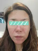 ダーマペン RAISE CLINIC 【レイズクリニック】 BEFORE サムネイル用