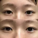 ボトックス（目尻） SK新宿歌舞伎町美容外科・歯科 BEFORE サムネイル用