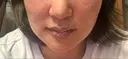 ニードルRF（ポテンツァなど） ゆう美容クリニック BEFORE サムネイル用