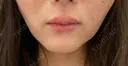人中短縮 / ヒアルロン酸注入（唇） / ボトックス（口角） DMTC CLINIC 日本橋院 BEFORE サムネイル用