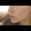 光治療（フォトフェイシャルなど） 品川スキンクリニック立川院 BEFORE サムネイル用