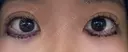 下まぶたたるみ取り きれいクリニック BEFORE サムネイル用