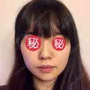 隆鼻術 / 鼻尖形成（切開） / 軟骨移植 / ワシ鼻修正・ハンプ切除 / 鼻尖縮小 表参道スキンクリニック 表参道院 BEFORE サムネイル用