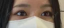 その他（目元） / 上まぶたの脂肪取り 9BeautyClinic BEFORE サムネイル用