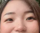 二重埋没 / 目頭切開 9BeautyClinic BEFORE サムネイル用