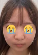 鼻尖形成（切開） / 小鼻縮小（切開） / 軟骨移植 / 鼻柱下降・鼻唇角形成（猫手術） / ヒアルロン酸注入（あご） グローバルビューティークリニック 東京院 BEFORE サムネイル用
