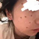 ピコスポット 日比谷セントラルクリニック BEFORE サムネイル用
