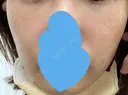 RF（高周波）たるみ治療 大塚美容形成外科 銀座本院 BEFORE サムネイル用