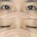 目尻切開 / タレ目形成・グラマラスライン（切開） 銀座高須クリニック BEFORE サムネイル用