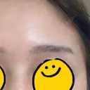 アートメイク（ほくろ） メディカルアートメイク大阪 BEFORE サムネイル用