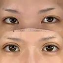 二重埋没 / ヒアルロン酸注入（あご） / ボトックス（エラ・小顔） / シワ取りボトックス アリエル美容クリニック 大宮院 BEFORE サムネイル用