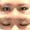 二重切開 つだ美容外科クリニック BEFORE サムネイル用