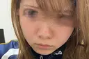 毛穴洗浄（ハイドラフェイシャルなど） / ポテンツァ A CLINIC（エークリニック） 銀座院 BEFORE サムネイル用