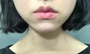 ヒアルロン酸注入（唇） / ボトックス（口角） TCB東京中央美容外科 堺院 BEFORE サムネイル用