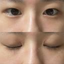 二重埋没 湘南美容クリニック 渋谷院 BEFORE サムネイル用