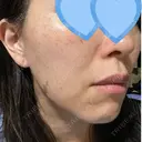 ルメッカ ルラ美容クリニック 渋谷本院 BEFORE サムネイル用