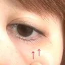 ピコスポット Fellez Clinic【フェルズクリニック】 BEFORE サムネイル用