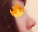 鼻尖形成（切開） / 軟骨移植 / ワシ鼻修正・ハンプ切除 / 小鼻縮小（非切開） 東京シンデレラ美容外科 池袋院 BEFORE サムネイル用