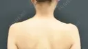 ボトックス（肩） 湘南美容クリニック 京都院 BEFORE サムネイル用