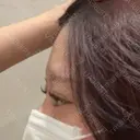 ヒアルロン酸注入（額） LA CLEF CLINIC（ラクレクリニック） BEFORE サムネイル用