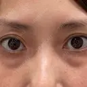 クマ治療 X CLINIC 銀座院 BEFORE サムネイル用