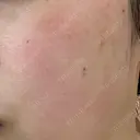 ピーリング（ニキビ・毛穴） LIFIX BEAUTY CLINIC BEFORE サムネイル用