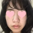 小鼻縮小（切開） JUN CLINIC BEFORE サムネイル用