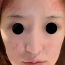 鼻尖形成（切開） / 鼻中隔延長（切開） / 脂肪注入（額） / 脂肪注入（輪郭） ビーザニュー美容整形外科（旧コノピ美容整形外科） BEFORE サムネイル用
