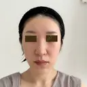 糸リフト / 額を丸く / 真皮移植 / 脂肪注入（額） / 切開リフト / 脂肪注入（輪郭） eクリニック 金沢本院 BEFORE サムネイル用
