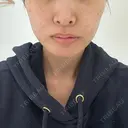 糸リフト / ヒアルロン酸注入（頬） EMMA CLINIC（エマクリニック） BEFORE サムネイル用