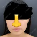 糸リフト / 脂肪吸引（顔） / ジョールファット除去 / ボトックス（エラ・小顔） ルラ美容クリニック 新宿院 BEFORE サムネイル用