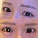 二重埋没 品川スキンクリニック 宇都宮院（※品川美容外科提携） BEFORE サムネイル用