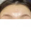 ボトックス（額） 美容皮膚科エルムクリニック 大阪院 BEFORE サムネイル用