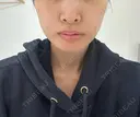 糸リフト / ヒアルロン酸注入（頬） EMMA CLINIC（エマクリニック） BEFORE サムネイル用