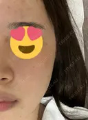 ピーリング（ニキビ・毛穴） LIFIX BEAUTY CLINIC BEFORE サムネイル用