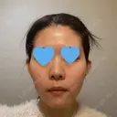 隆鼻術 / 鼻中隔延長（切開） / 鼻翼基部形成（貴族手術） ヴェリテクリニック 銀座院 BEFORE サムネイル用