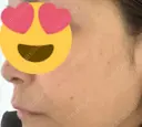 シミ取りレーザー Mavie Beauty Clinic （マヴィービューティークリニック） BEFORE サムネイル用