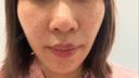小鼻縮小（切開） / 人中短縮 / 鼻翼挙上 Otus Clinic 【オータスクリニック】 BEFORE サムネイル用